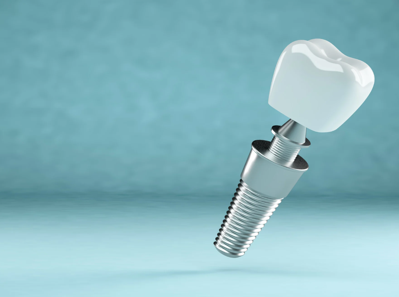 Impianti dentali vs. Protesi dentarie: Quale fa per te?
