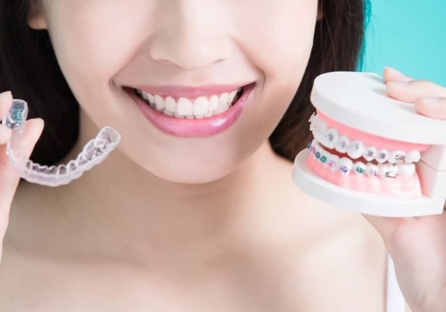 Ortodonzia per Adulti: Perché Non è Mai Troppo Tardi per Allineare i Denti